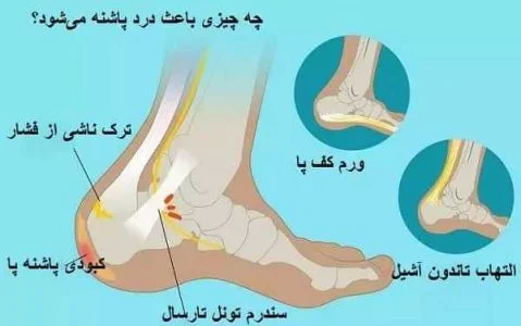 علت درد پاشنه پا سمت چپ در مردان