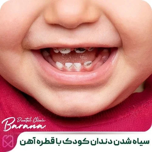آهن | مکمل ارتباط مصرف مکمل آهن و پوسیدگی دندان