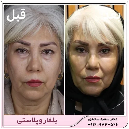 دوره نقاهت بلفاروپلاستی چقدر است؟